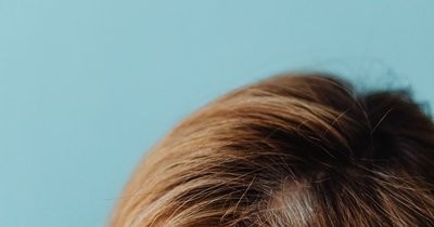 Haarausfall bei Vitamin-D-Mangel